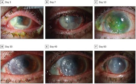 Clinical Features And Treatment Outcomes Of Carbapenem Resistant