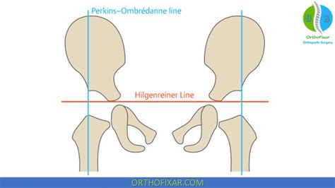 Ddh Radiology Orthofixar 2025