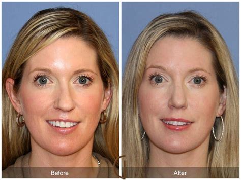 Tip Rhinoplasty Before After Photos From Dr Kevin Sadati