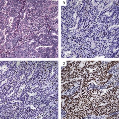 High Grade Endometrial Adenocarcinoma A And B In A 77 Year Old Woman Download Scientific