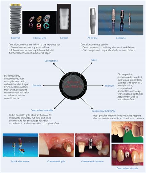 54 Implant Abutments Pocket Dentistry