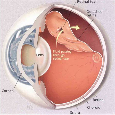 Cemoa Descolamento Da Retina