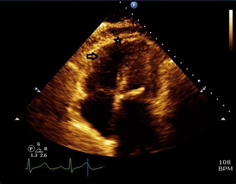 mcconnell sign Mcconnell pulmonary embolism bmj casereports - IMAGE FLUENT