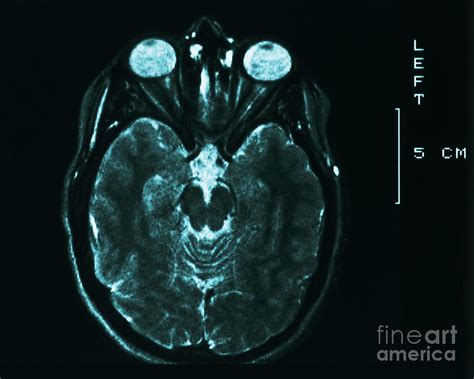 Mri Of Normal Brain 29 By Science Source