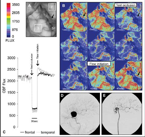 Figure 2 From Intraoperative Monitoring Of Cerebral Blood Flow By Laser