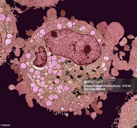 Carcinoma Cell Colored Transmission Electron Micrograph High Res Vector