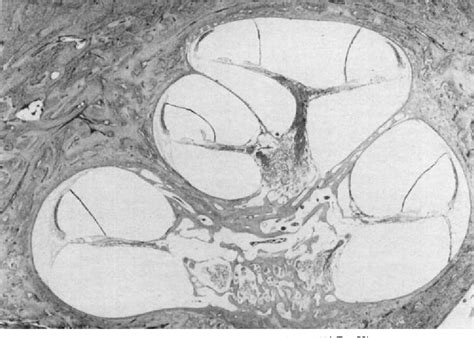 Figure From Endolymphatic Hydrops With Absence Of Vein In