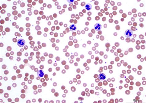 Pathology Outlines Chronic Neutrophilic Leukemia