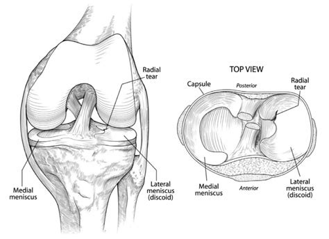 Causes of Discoid Meniscus | David Slattery