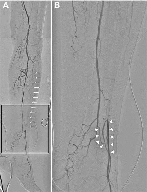 Figure 1 From Transcollateral Retrograde Approach With Rendezvous