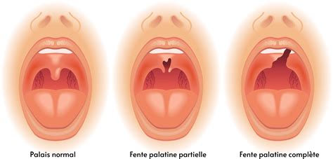 Fente Palatine Causes Sympt Mes Et Traitements