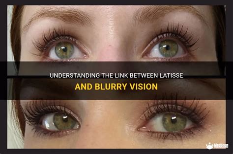 Understanding The Link Between Latisse And Blurry Vision Medshun