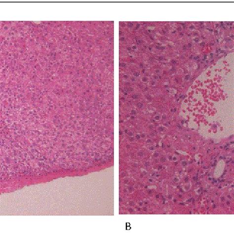 Liver histology: Liver biopsy shows hemorrhagic necrosis (A) and ...