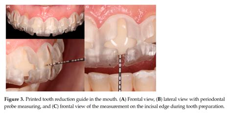 Printed Tooth Reduction Guide In The Mouth A Frontal View B