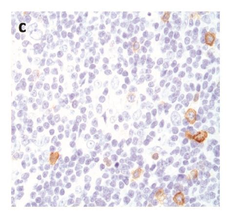 Nodular Lymphocyte Predominant Hodgkin Lymphoma A Lymphocyte