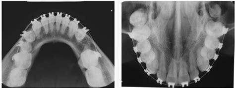 Radiografia Oclusal CROC DIGITAL