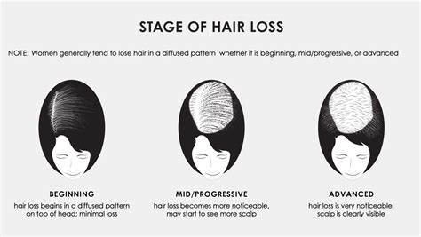 Stages of Hair Loss - Jon Renau Collection