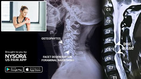 Case study: Cervical radiculopathy - Injection - NYSORA