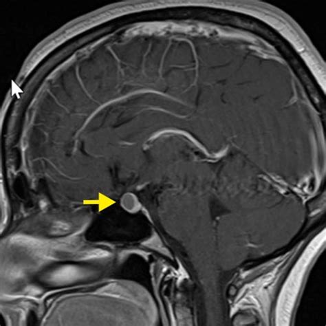 Rathke Zysten Diagnose Therapie Neurochirurgie Inselspital Bern