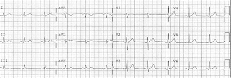 Dr. Smith's ECG Blog: November 2017