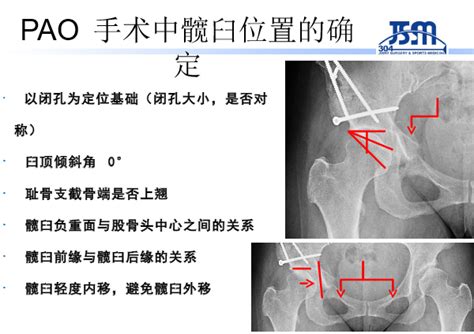 如何完成标准的髋臼周围截骨术 好医术早读文章 好医术 赋能医生守护生命