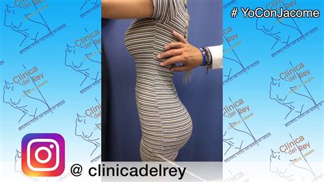 Implantes De Gluteos En Clinica De Rey Dr Franco Reyes Jacome YouTube