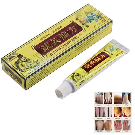 Buy Natural Chinese Al Eczema Psoriasis Cream Dermatitis Pruritus Ointment External Anti Itch