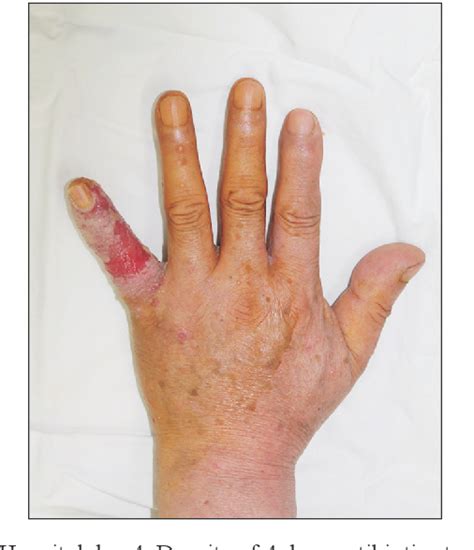 Figure 3 From Staphylococcal Scalded Skin Syndrome In A Healthy Adult