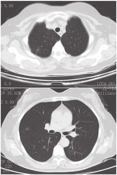 Chest Radiography Six Months Post Treatment Showing A Complete