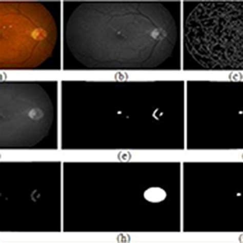 Retinal structure of optic disc, optic cup, and varying location in... | Download Scientific Diagram