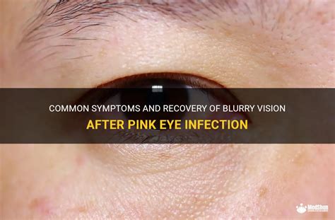 Common Symptoms And Recovery Of Blurry Vision After Pink Eye Infection ...