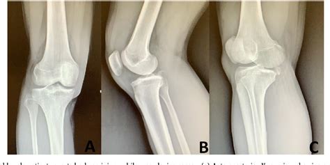 Figure From Osteochondral Avulsion Fracture Of The Posteromedial