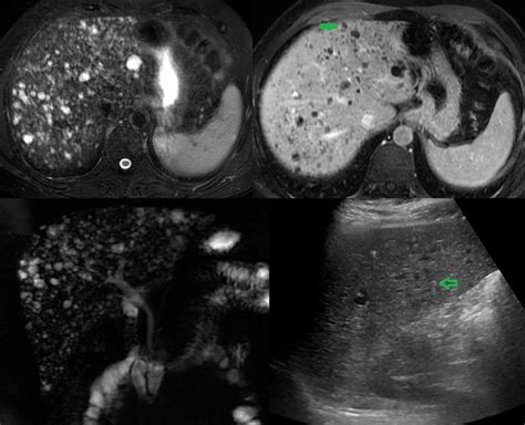 Biliary Duct Hamartoma Statpearls Ncbi Bookshelf