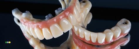 Diferencias entre prótesis dental y puentes dentales