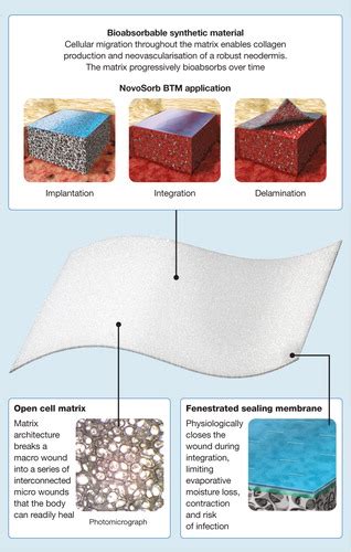 Use Of A Bilayer Biodegradable Synthetic Dermal Matrix For The Management Of Defects Arising