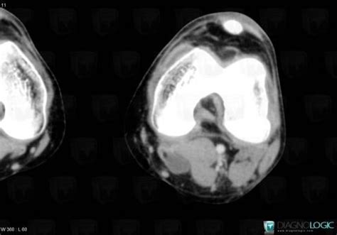 Cas Radiologie Kyste Poplit Scanner Diagnologic