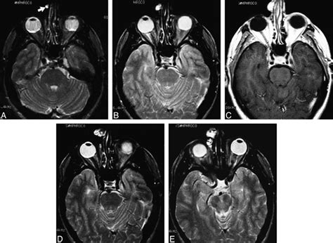 Recurrence Of Clival Chordoma Along Thesurgical Pathway American