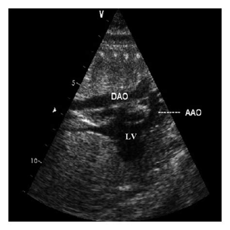 Patent Ductus Arteriosus Pda 38 W A The Long Axis Of Aortic Arch Download Scientific