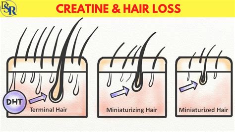 👉 Creatine And Hair Loss Real Scientific Truth Youtube