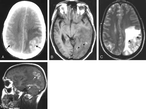 Primary Amebic Meningoencephalitis