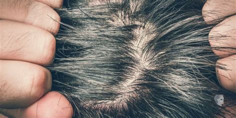 Itchy Scalp and Hair loss: How to Treat Naturally - AHS India - AHS India