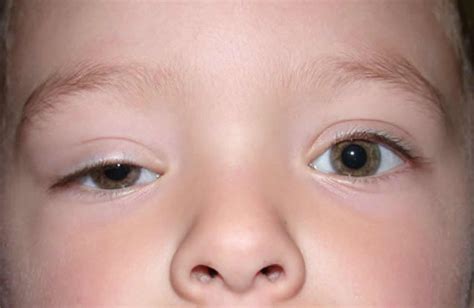 Ptosis Droopy Eyelid Causes Droopy Eyelid Treatment And Ptosis Surgery