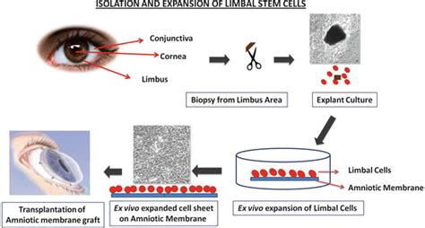 Cellular Therapy For Ocular Diseases Basicmedical Key