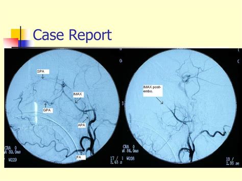 Ppt Hard Palate Necrosis After Bilateral Internal Maxillary Artery Embolization For Epistaxis