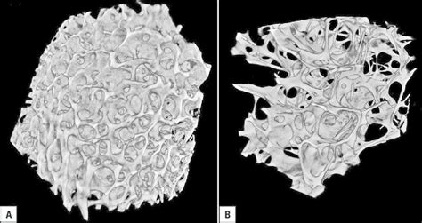 Volume Rendering Of The Spongy Bone From Human Lumbar Vertebrae