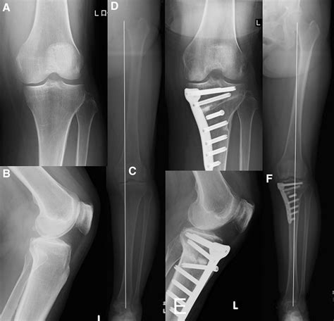 Distal Tibial Osteotomy