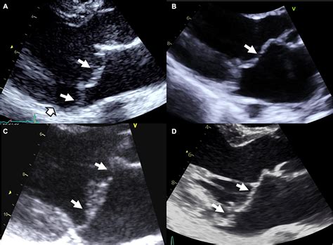 Frontiers | Genetics and pathophysiology of mitral valve prolapse