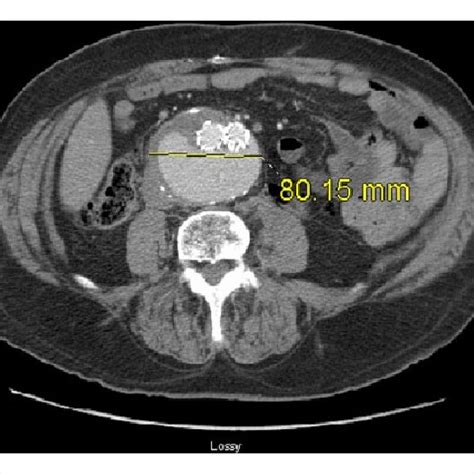 Pre Operative Angiogram Demonstrating Type Iiib Endoleak From Proximal