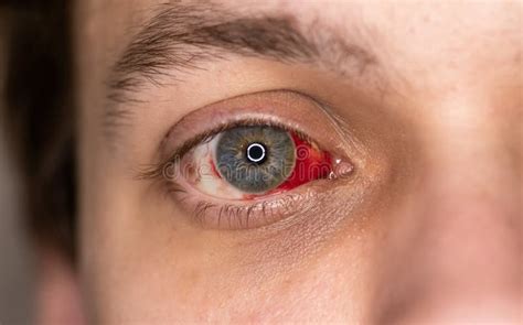 Ojo Humano Con Hemorragia Subconjuntival Visible Sangre En El Ojo