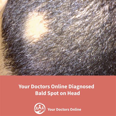 How Your Doctors Online Helped Diagnose the Bald Spot on Head